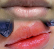 Tại sao nên khử thâm môi tại Yuki spa ?