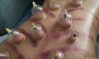 Cạo Gió Giác Hơi