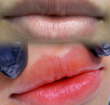 Tại sao nên khử thâm môi tại Yuki spa ?